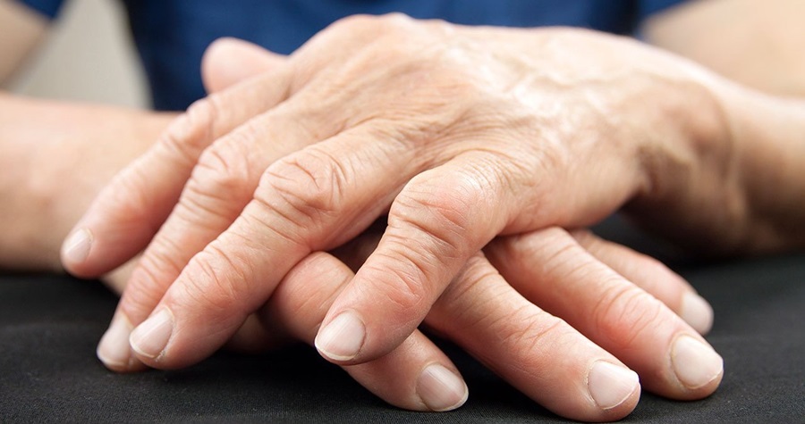 Unas manos sobre una mesa muestran dedos deformes por la artritis reumatoide 