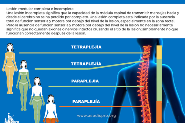 Infografía En un gráfico, se señala las áreas de la columna que al ser afectadas producen tetraplejía o paraplejía. Se describe qué es lesión completa e incompleta.
